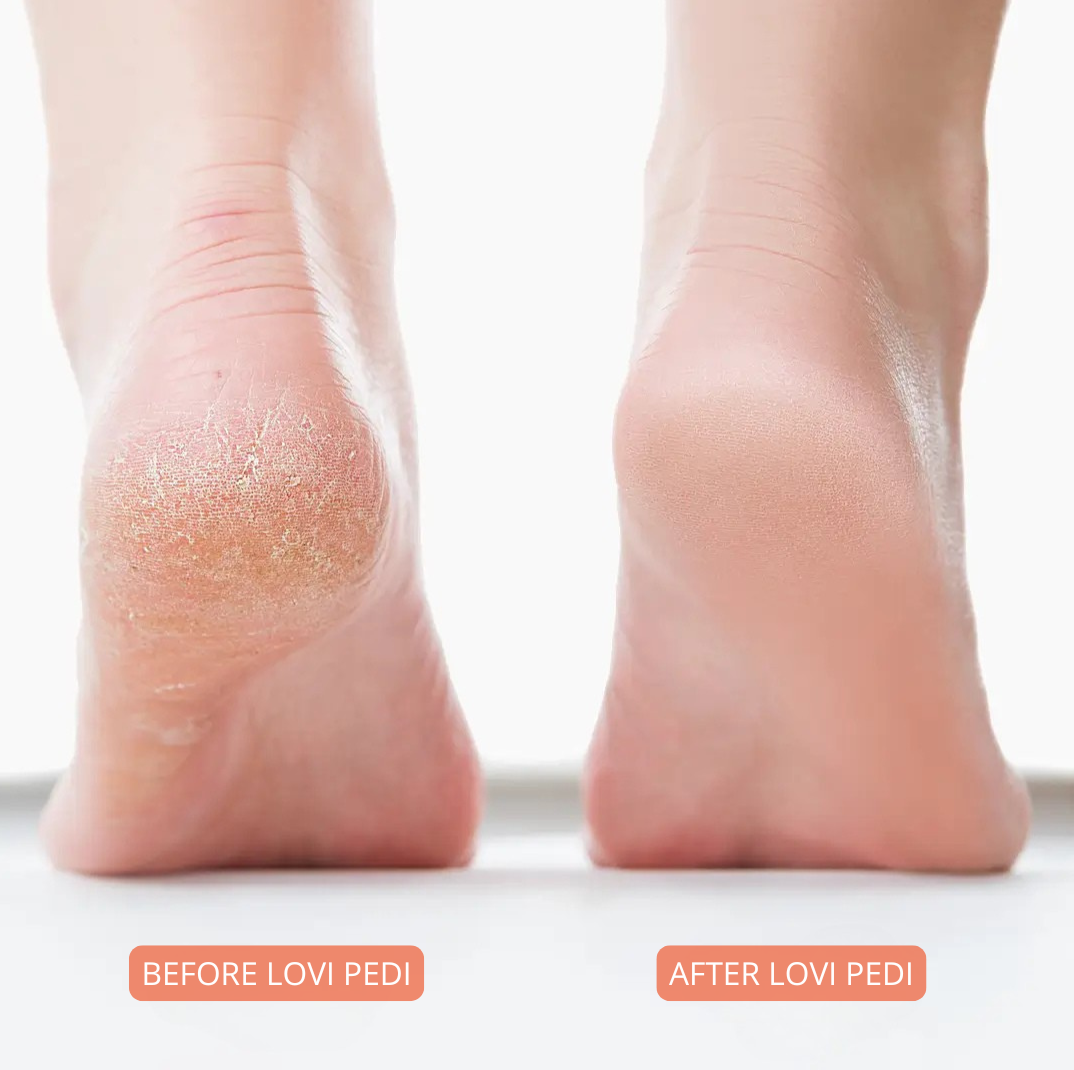 Lovi Pedi Pro 2